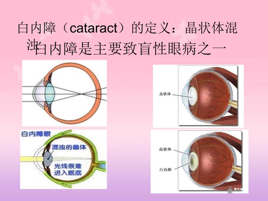 白内障和青光眼病人的护理_第2页