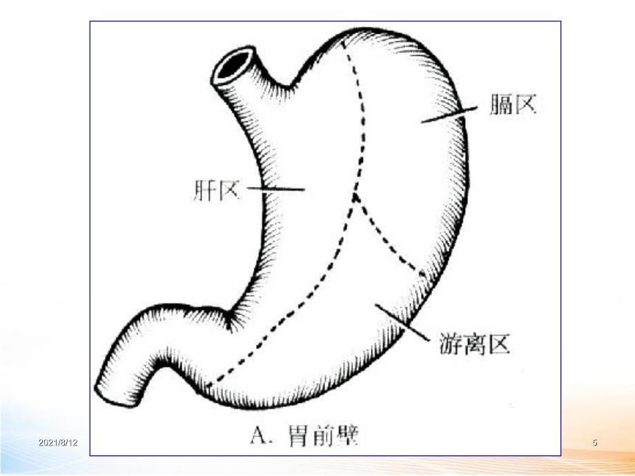 胃大部切除术 课件讲座_第5页