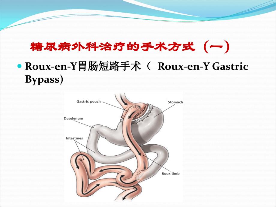 型糖尿病人的手术决策ppt课件_第4页