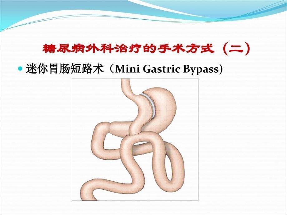 型糖尿病人的手术决策ppt课件_第5页