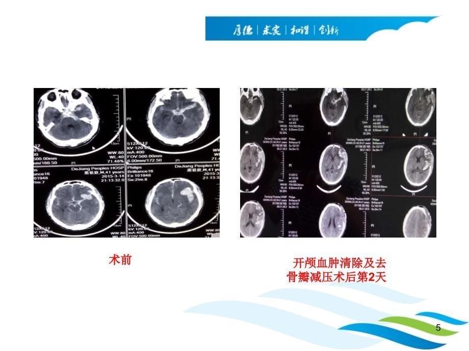 神经介入病例讨论ppt参考课件_第5页