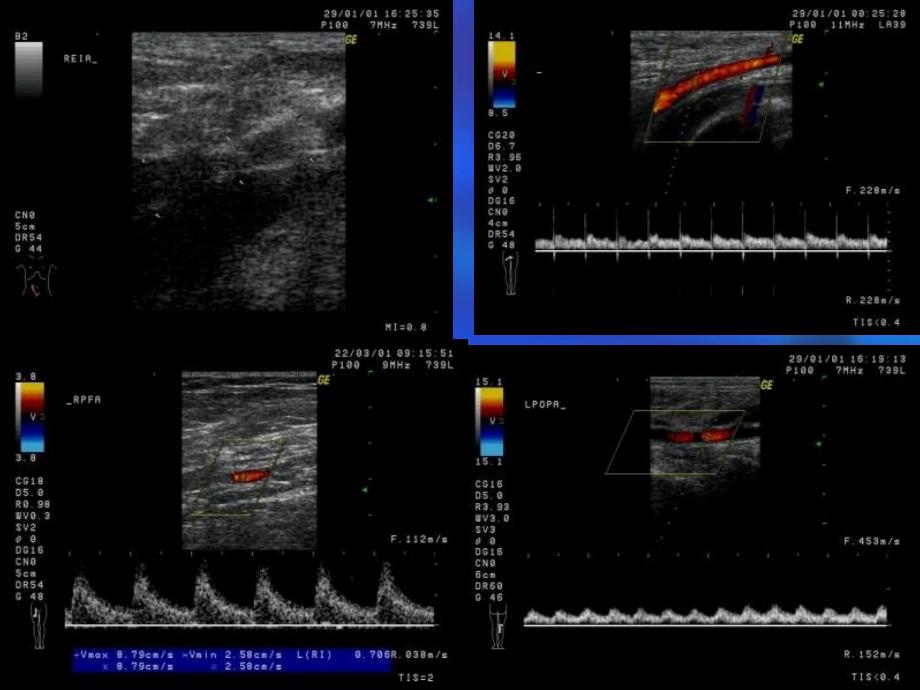 外周血管疾病的超声诊断_第4页