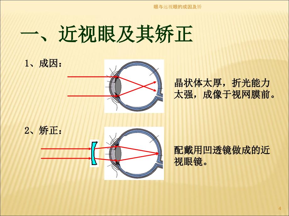 眼与远视眼的成因及矫课件_第4页