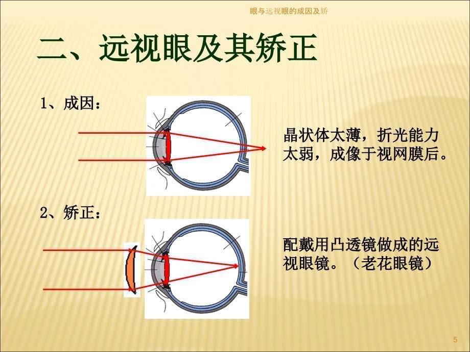 眼与远视眼的成因及矫课件_第5页