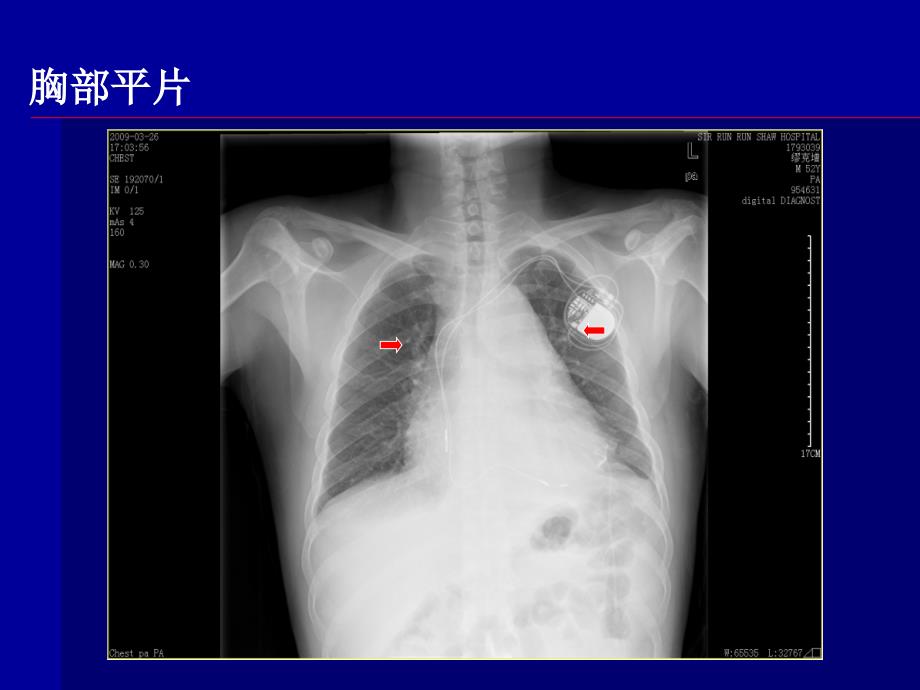 内科学进展：弥漫大B细胞淋巴瘤治疗进展_第4页