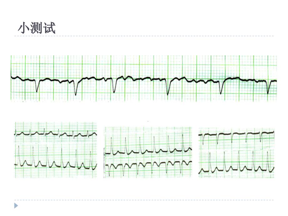 icu常见心律失常课件_第2页