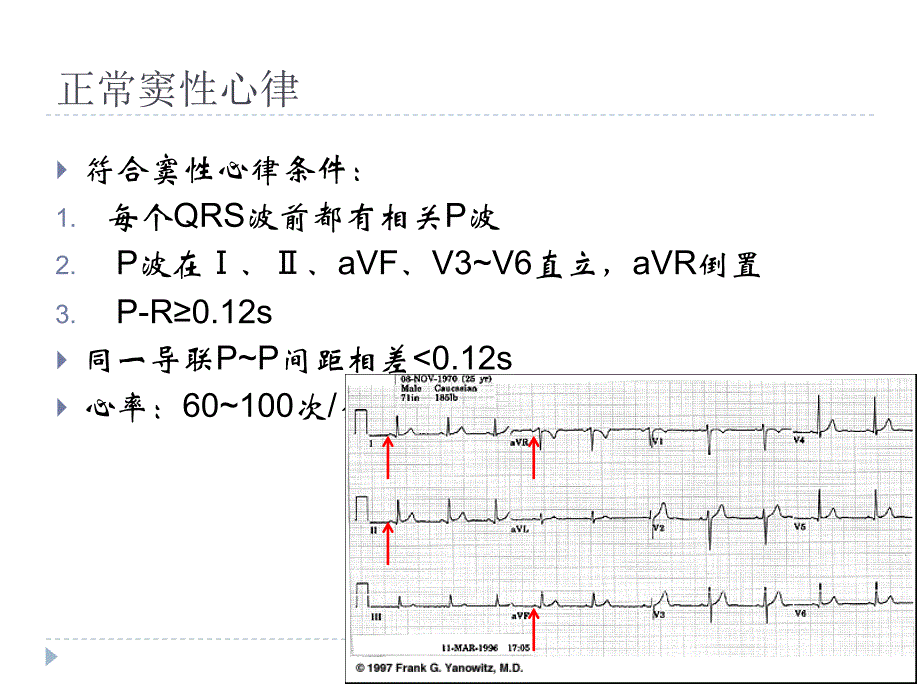 icu常见心律失常课件_第4页