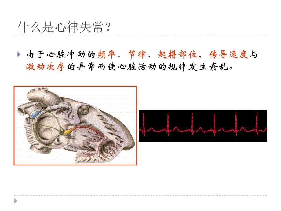 icu常见心律失常课件_第5页