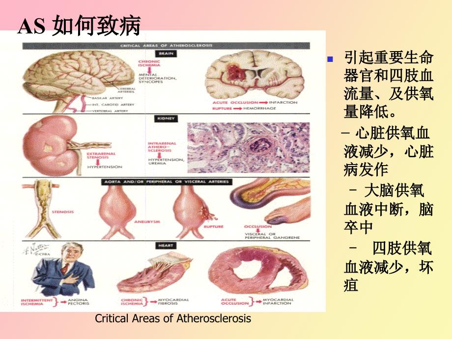 调血脂和抗动脉粥样硬化药物_第4页