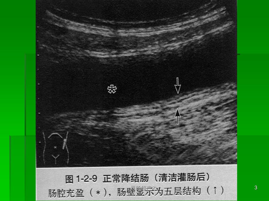 胃肠超声之课件_第3页