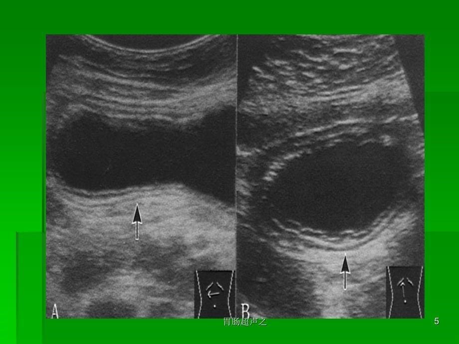 胃肠超声之课件_第5页