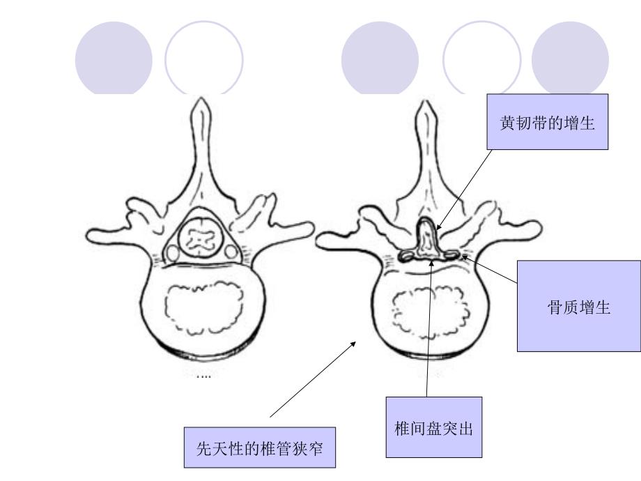 腰椎管狭窄症_第3页