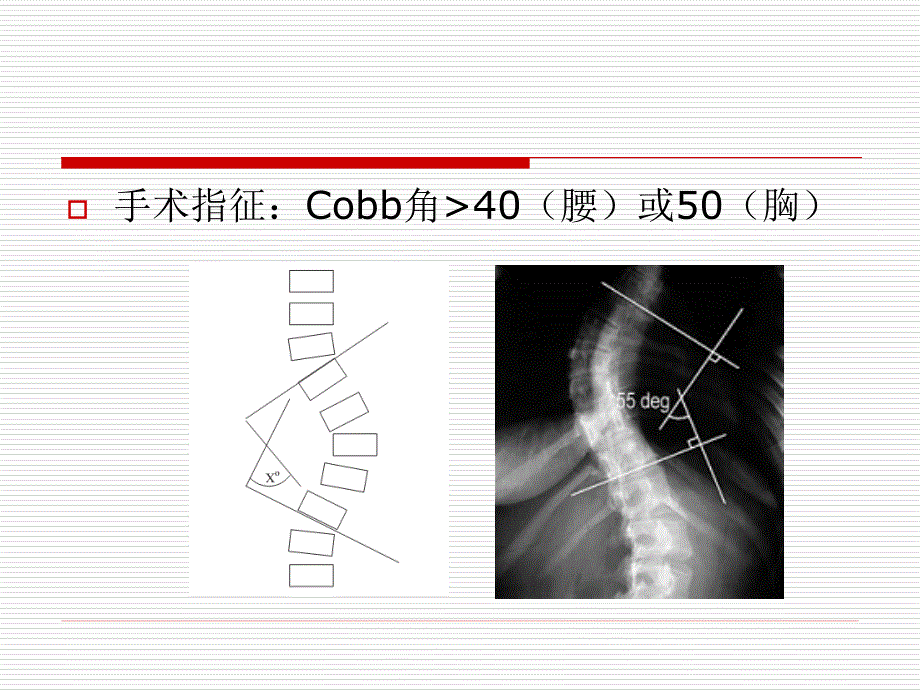 脊柱侧弯矫形术的麻醉问题_第3页