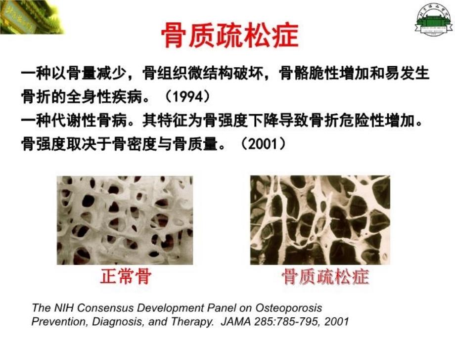 最新原发性骨质疏松症修改PPT课件_第3页