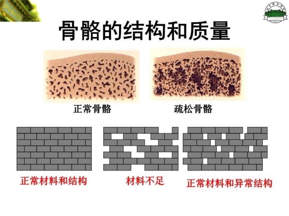 最新原发性骨质疏松症修改PPT课件_第4页