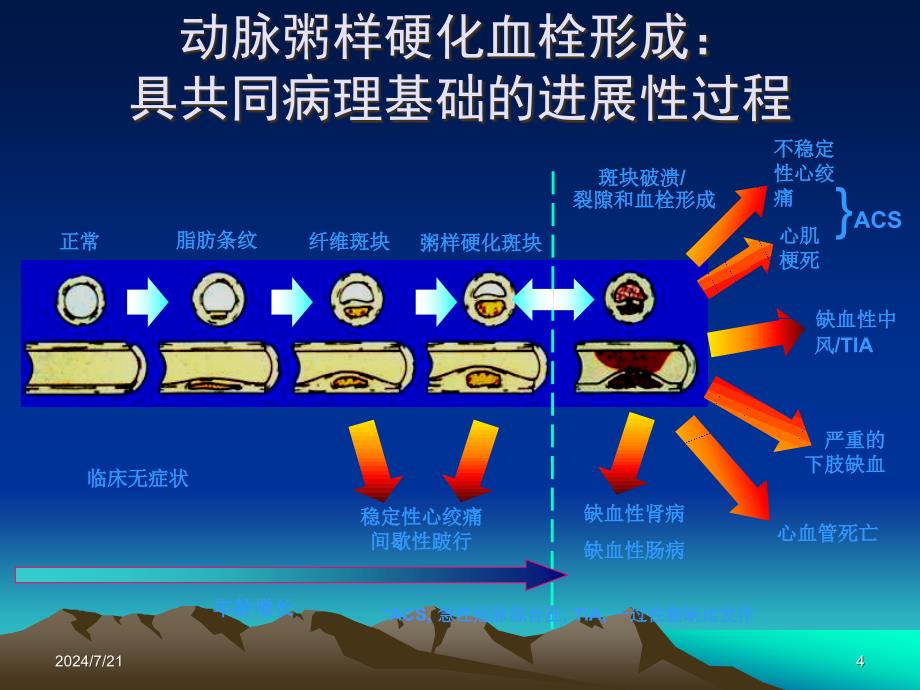 冠心病病例讨论ppt参考课件_第4页