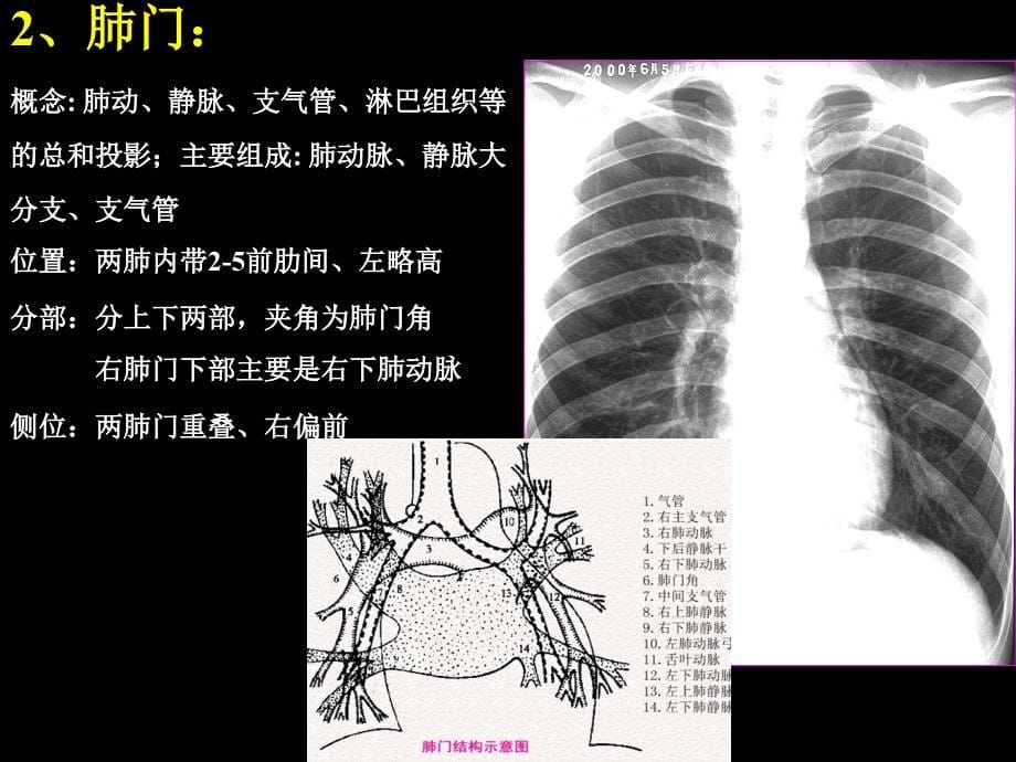 技能1：呼吸系统疾病X线诊断_第5页