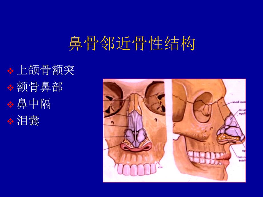 鼻骨骨折影像学诊断课件_第3页