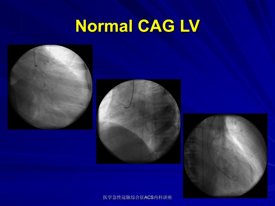 医学急性冠脉综合征ACS内科讲座课件_第3页