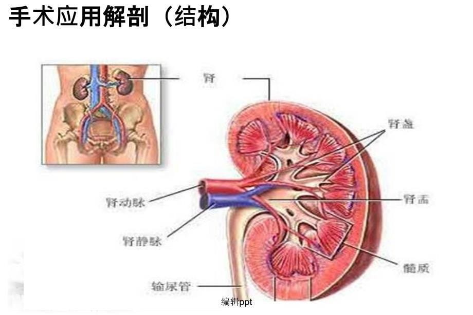 后腹腔镜肾部分切除术护理配合_第5页