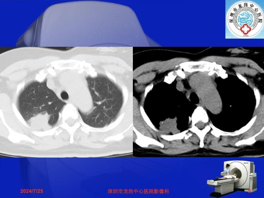 影像科经典读片之二肺炎性假瘤影像诊断分析ppt课件_第5页