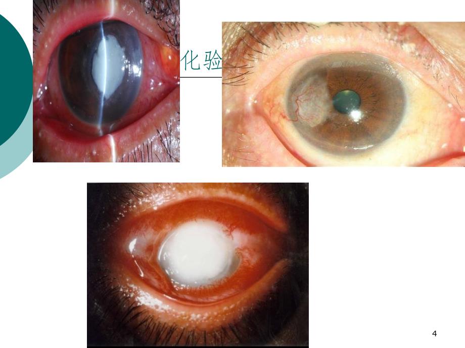 角膜炎护理查房(课堂PPT)_第4页