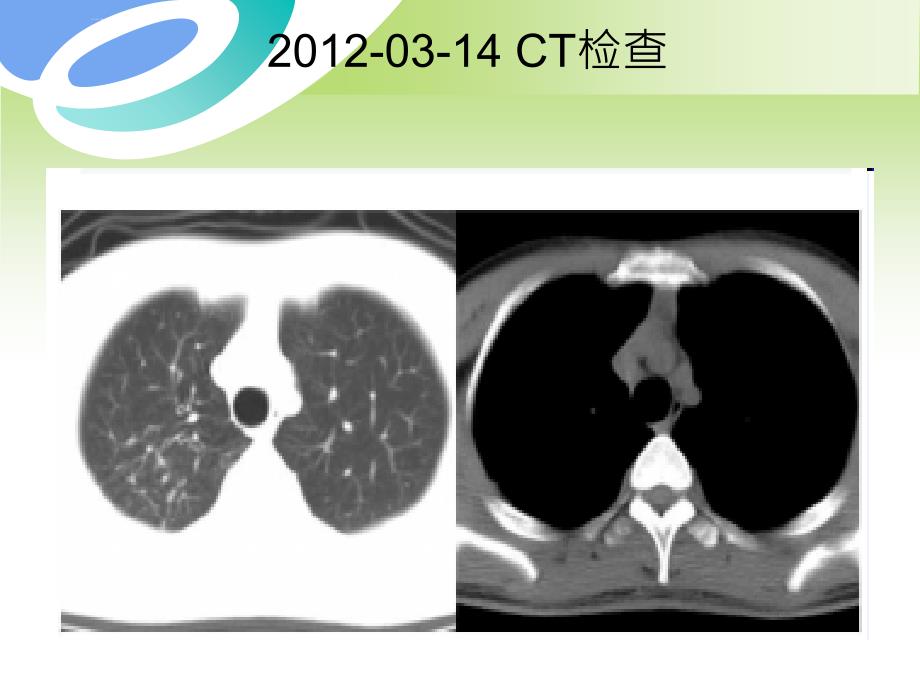 纵隔卵黄囊瘤ppt课件_第3页