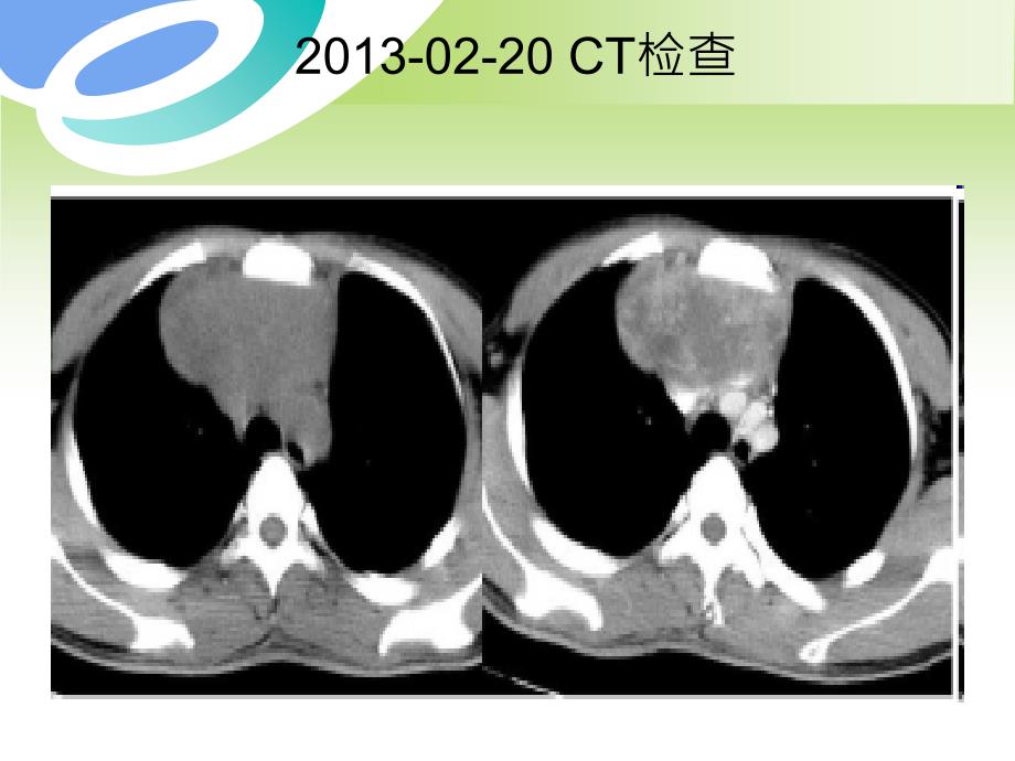 纵隔卵黄囊瘤ppt课件_第4页