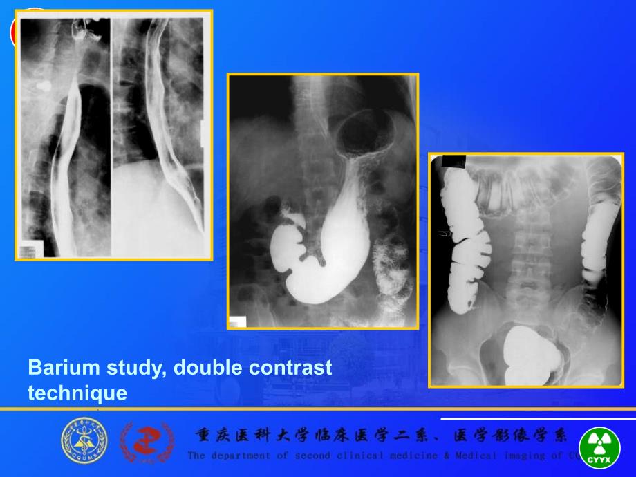 食管与胃肠道的影像诊断重医医学影像学课件_第4页