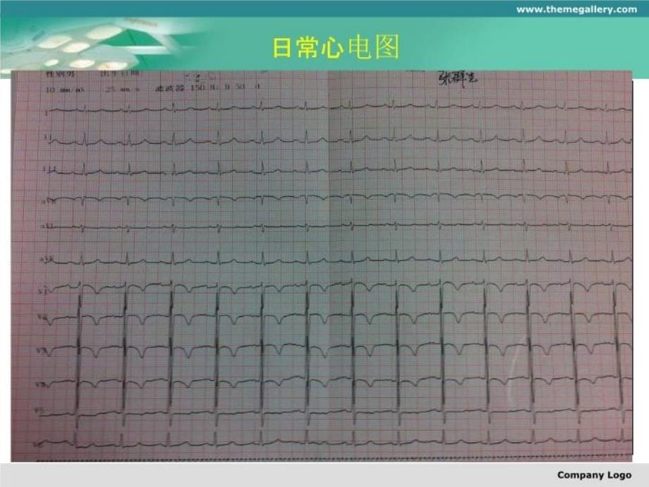 最新右冠闭塞前降支严重扭曲钙化介入治疗一例ppt课件_第4页