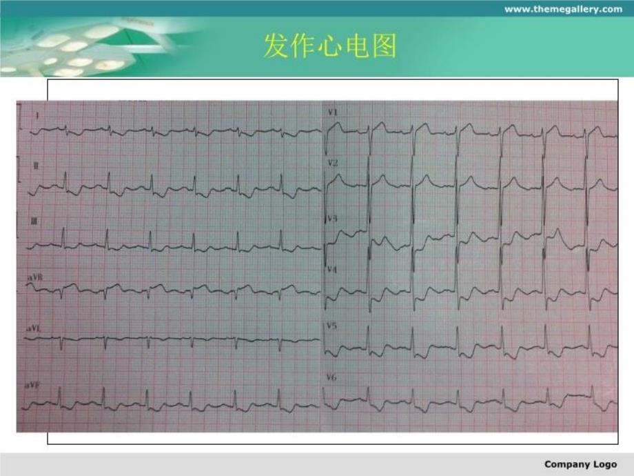 最新右冠闭塞前降支严重扭曲钙化介入治疗一例ppt课件_第5页