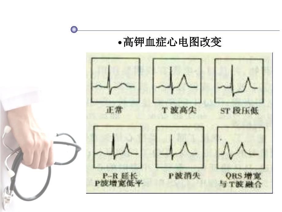 电解质紊乱和药物对心电图的影响_第5页