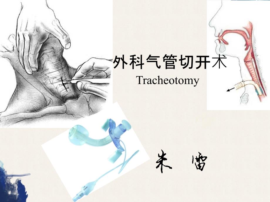 气管切开术Tracheotomy_第2页