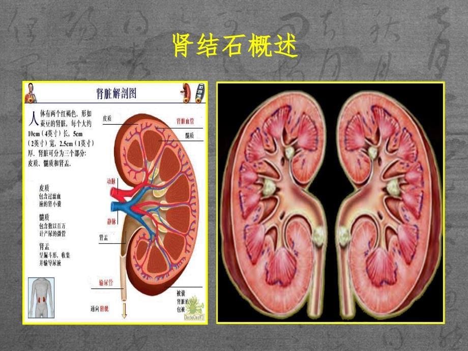 经皮肾镜碎石取石术后护理查房PPT精品文档_第5页