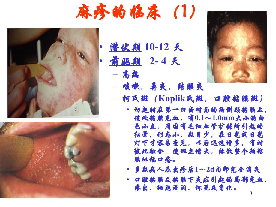 麻疹教育系统ppt课件_第3页