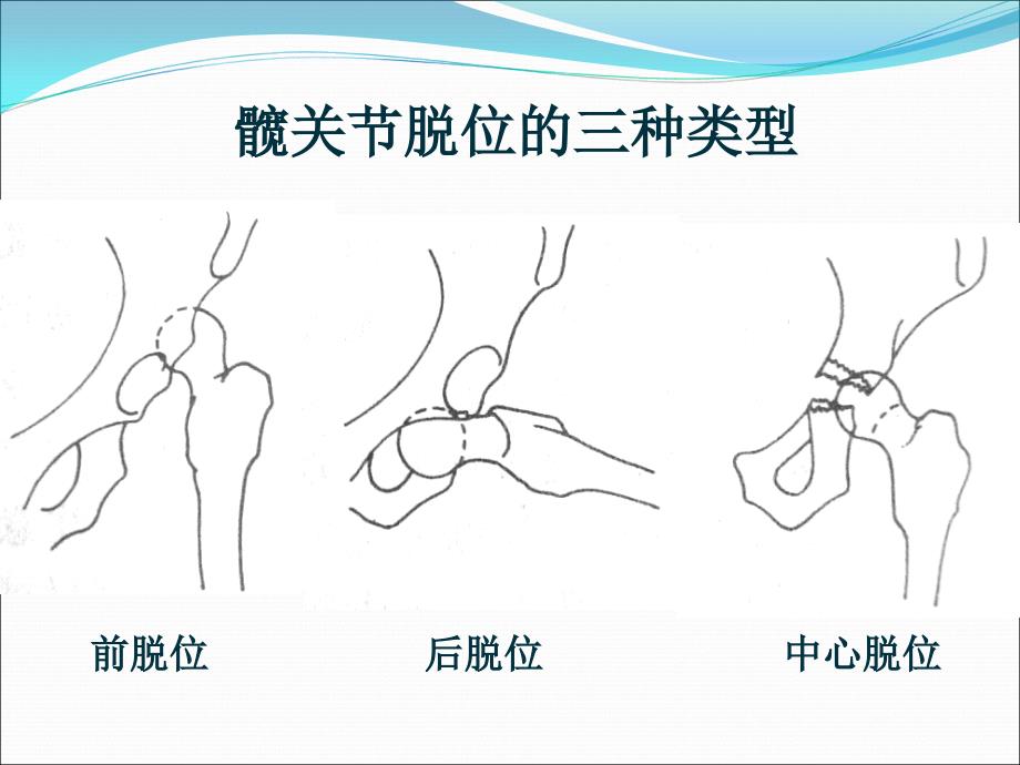 下肢骨关节损伤课件_第3页