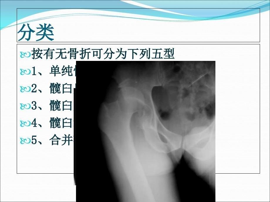 下肢骨关节损伤课件_第5页