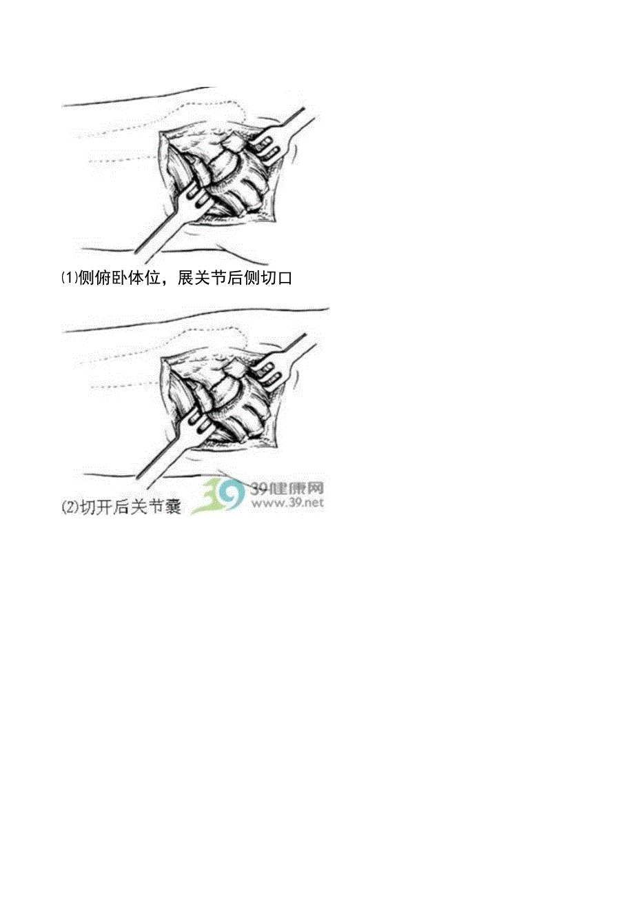 人工股骨头置换术手术步骤详解_第3页