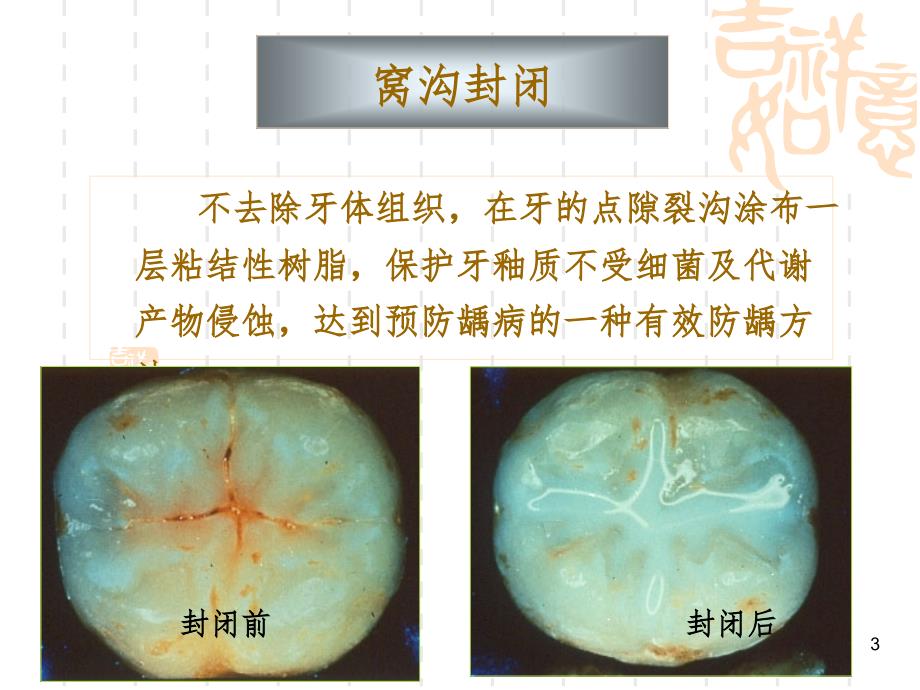 窝沟封闭文档资料_第3页