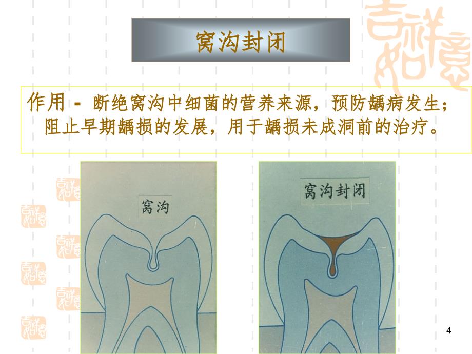 窝沟封闭文档资料_第4页