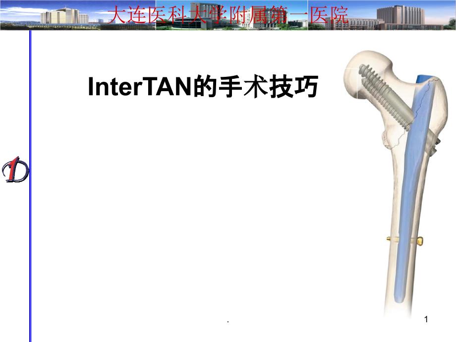 Intertan的手术技巧_第1页