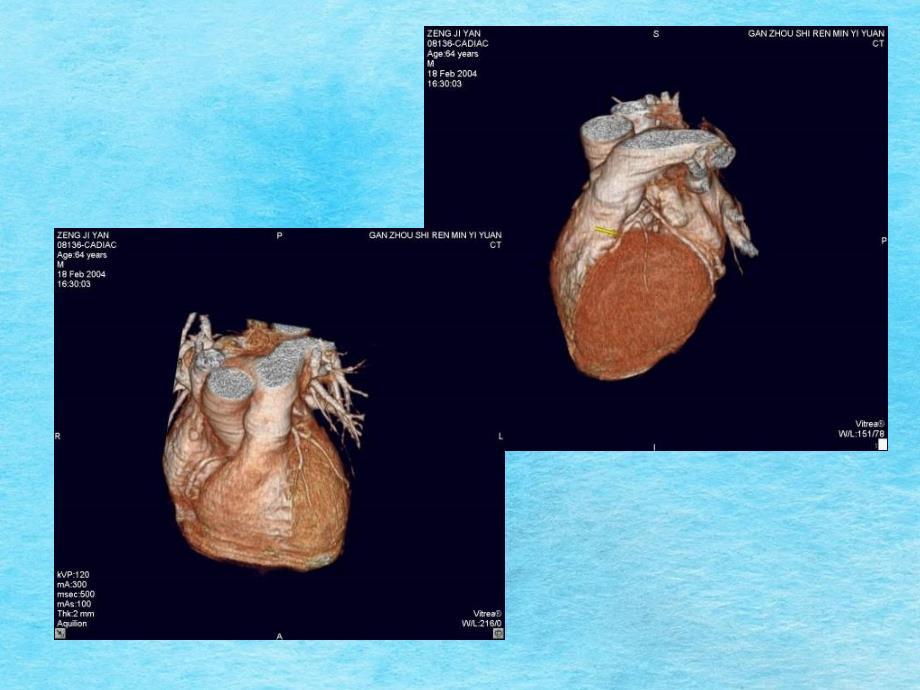 冠状动脉CT三维成像的临床应用雷剑ppt课件_第3页