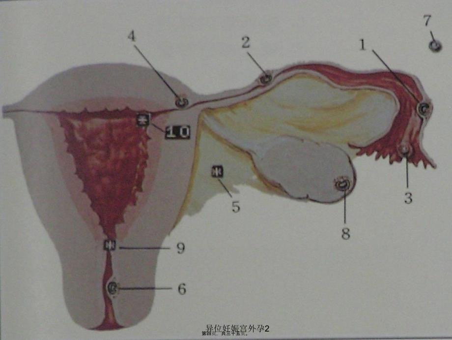 异位妊娠宫外孕2课件_第4页