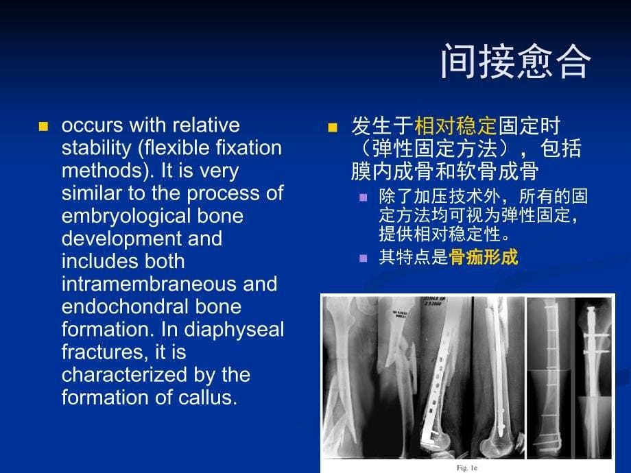 应变理论在骨折愈合中的临床应用_第5页