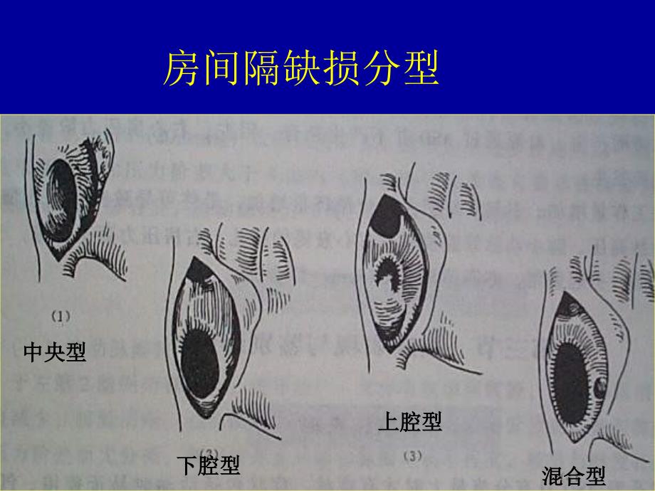 先心病封堵器研制现状概要_第3页