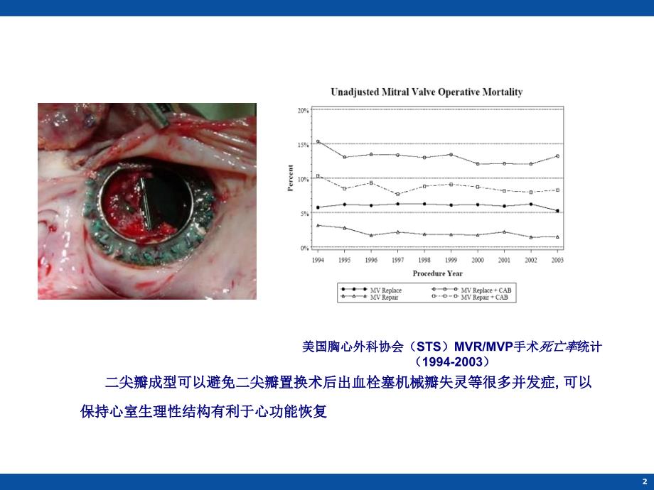 二尖瓣瓣环形技术ppt课件_第2页