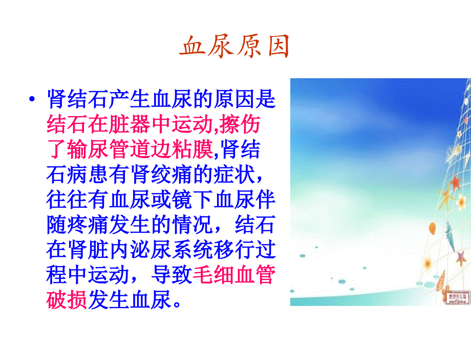 肾输尿管结石()_第4页