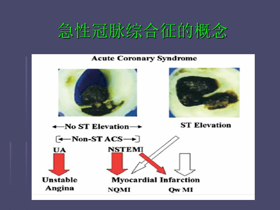 急性冠脉综合征合心律失常_第2页