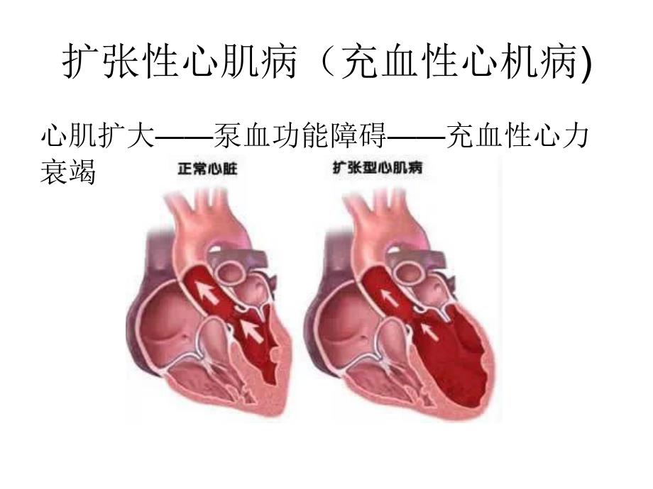 《扩张性心肌病》PPT课件.ppt_第4页