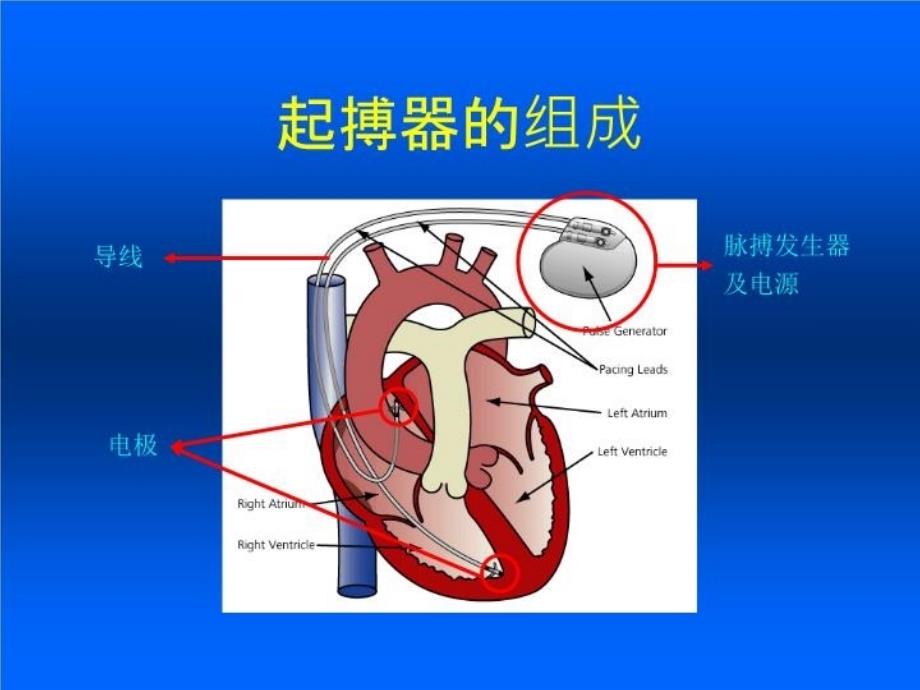 最新心外_临时起搏器PPT课件_第3页